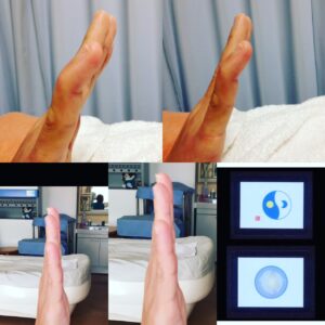 突き指症例写真